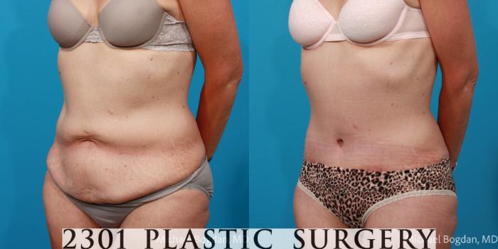 Before & After Tummy Tuck Case 697 Left Oblique View in Fort Worth, Plano, & Frisco, Texas