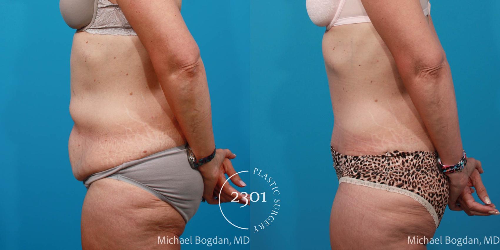 Before & After Tummy Tuck Case 697 Left Side View in Fort Worth, Plano, & Frisco, Texas