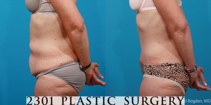Before & After Tummy Tuck Case 697 Left Side View in Fort Worth, Plano, & Frisco, Texas