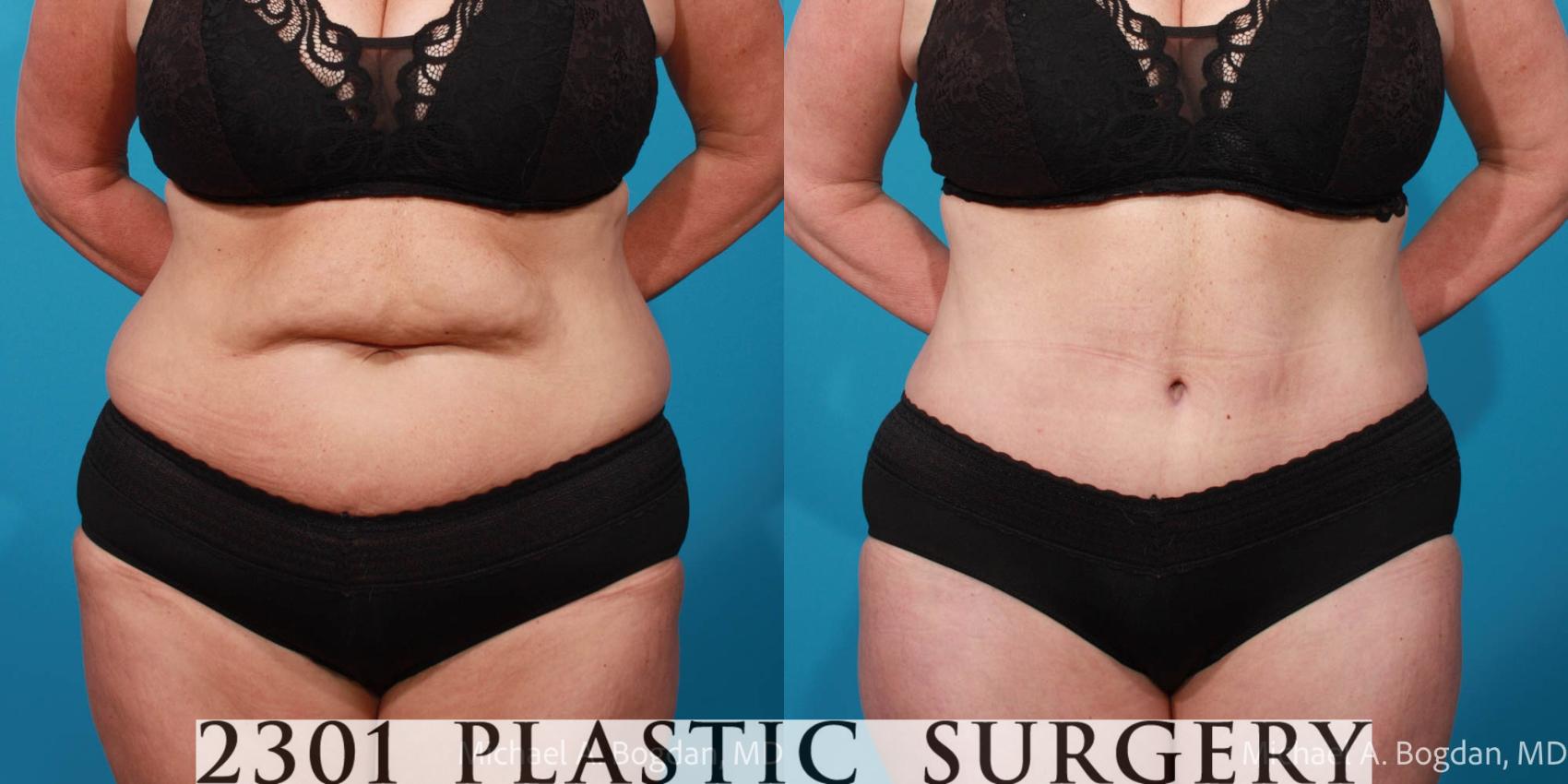 Before & After Tummy Tuck Case 707 Front View in Fort Worth, Plano, & Frisco, Texas