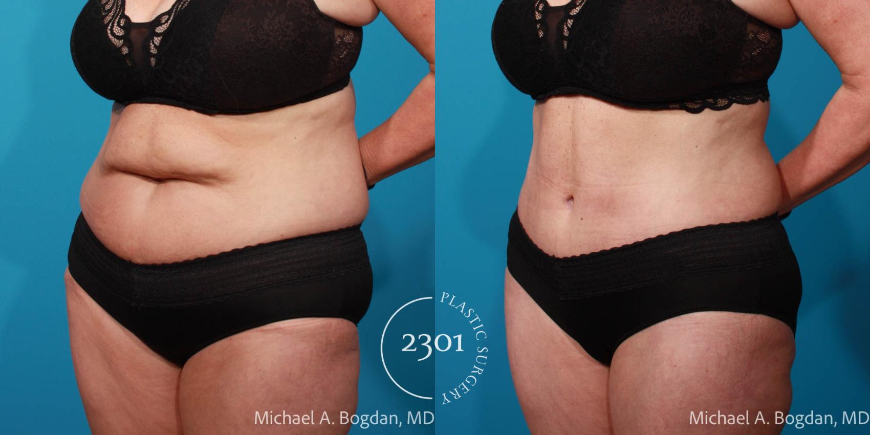 Before & After Tummy Tuck Case 707 Left Oblique View in Fort Worth, Plano, & Frisco, Texas
