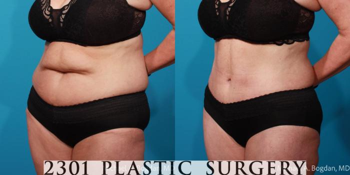 Before & After Tummy Tuck Case 707 Left Oblique View in Fort Worth, Plano, & Frisco, Texas