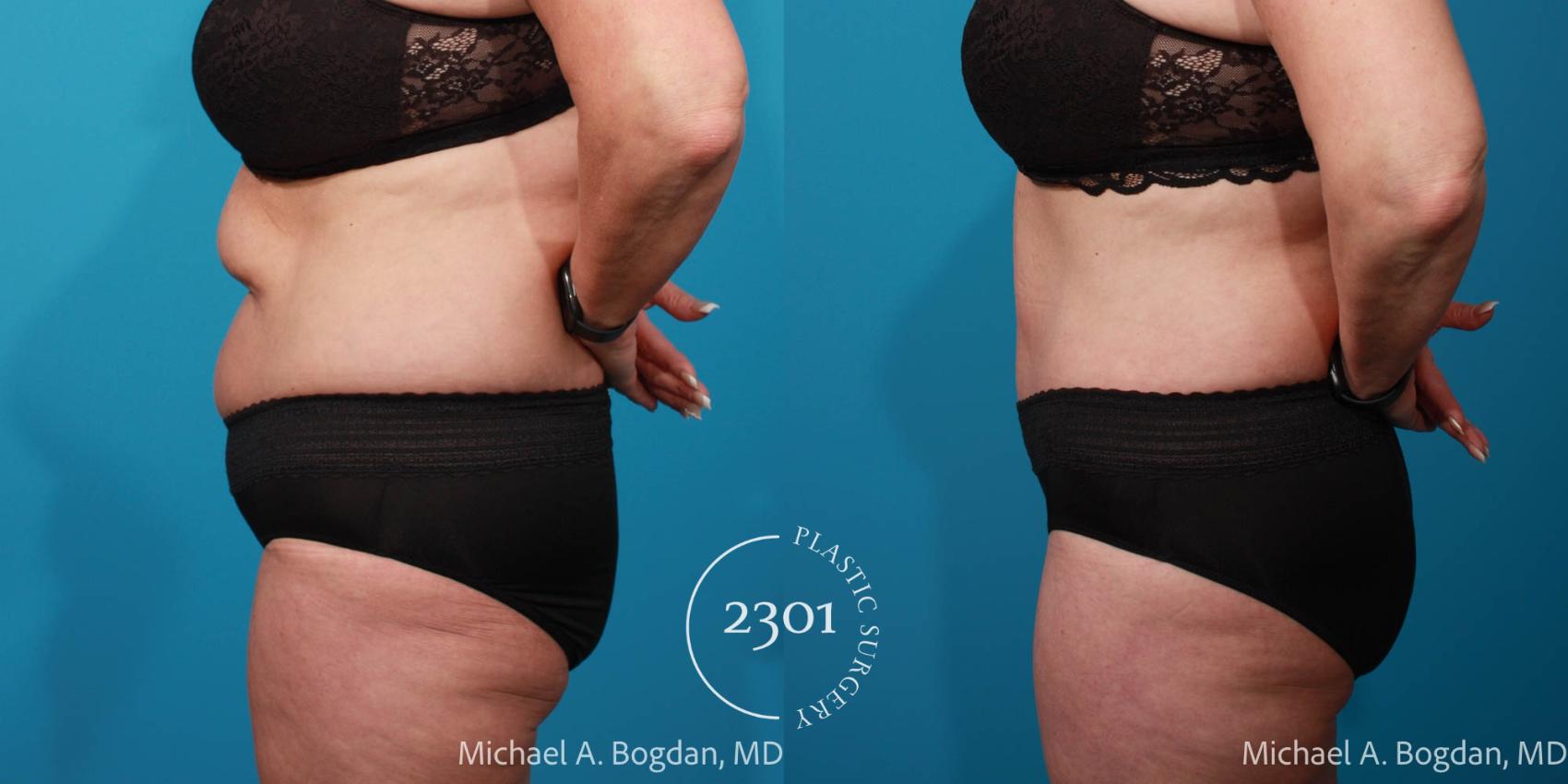 Before & After Tummy Tuck Case 707 Left Side View in Fort Worth, Plano, & Frisco, Texas