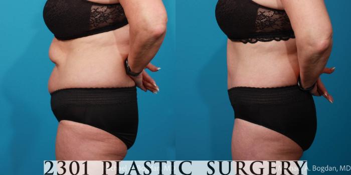 Before & After Tummy Tuck Case 707 Left Side View in Fort Worth, Plano, & Frisco, Texas