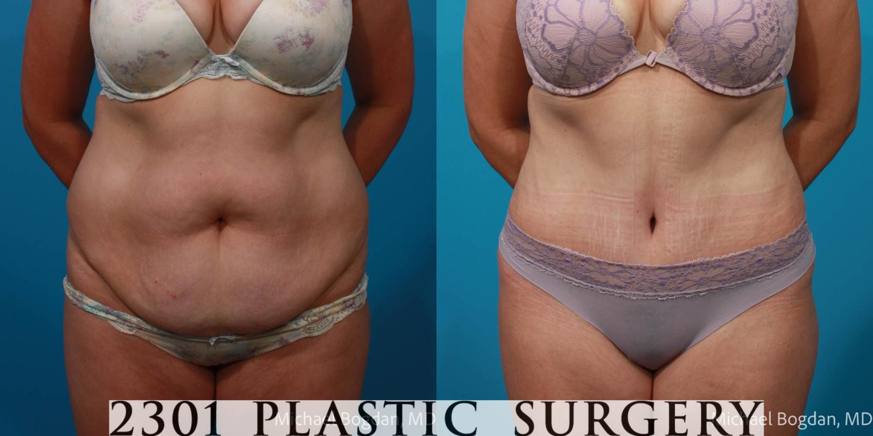 Before & After Tummy Tuck Case 708 Front View in Fort Worth, Plano, & Frisco, Texas