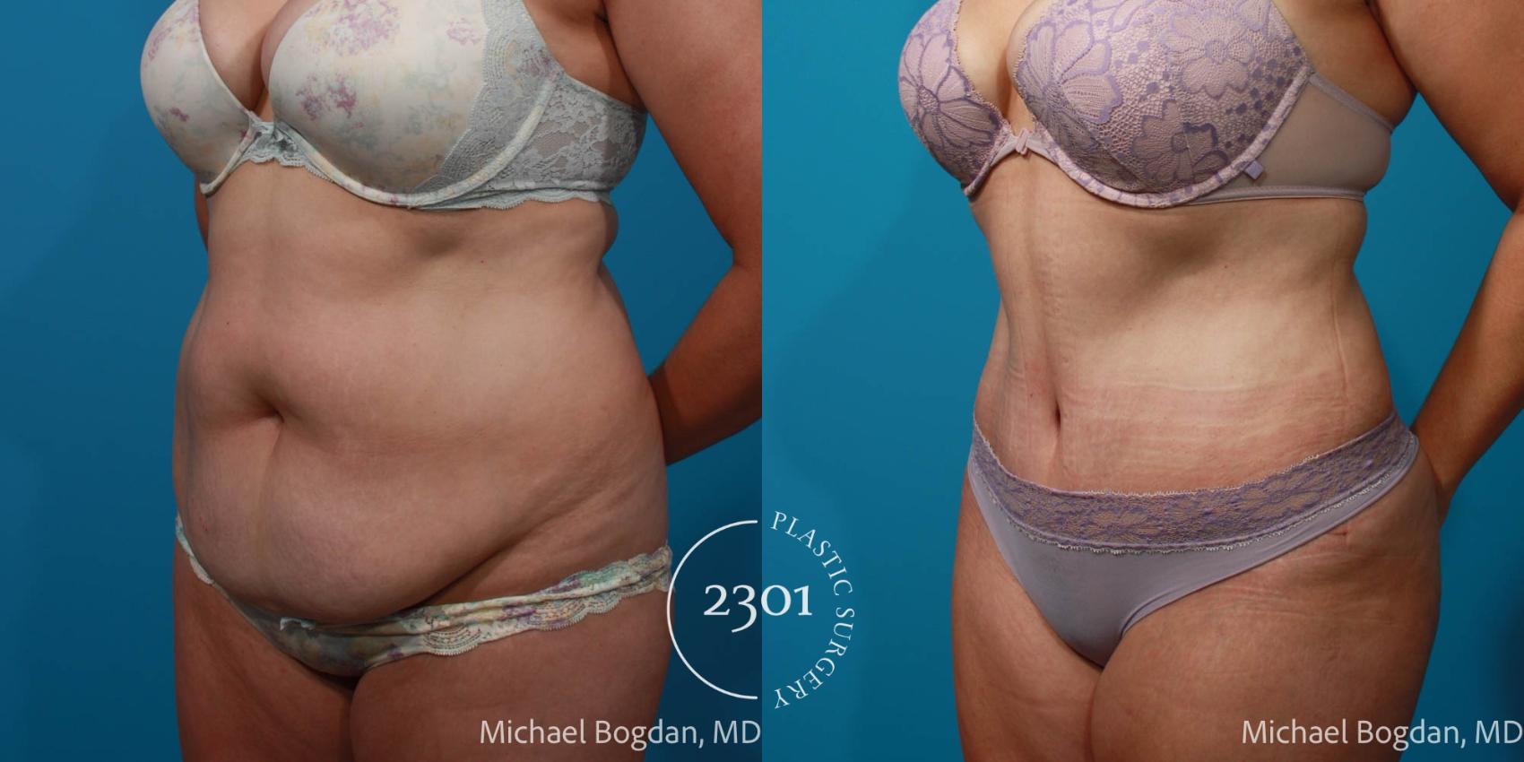 Before & After Tummy Tuck Case 708 Left Oblique View in Fort Worth, Plano, & Frisco, Texas