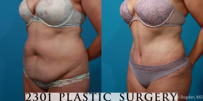Before & After Tummy Tuck Case 708 Left Oblique View in Fort Worth, Plano, & Frisco, Texas