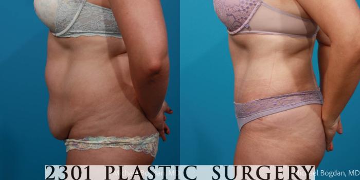 Before & After Tummy Tuck Case 708 Left Side View in Fort Worth, Plano, & Frisco, Texas