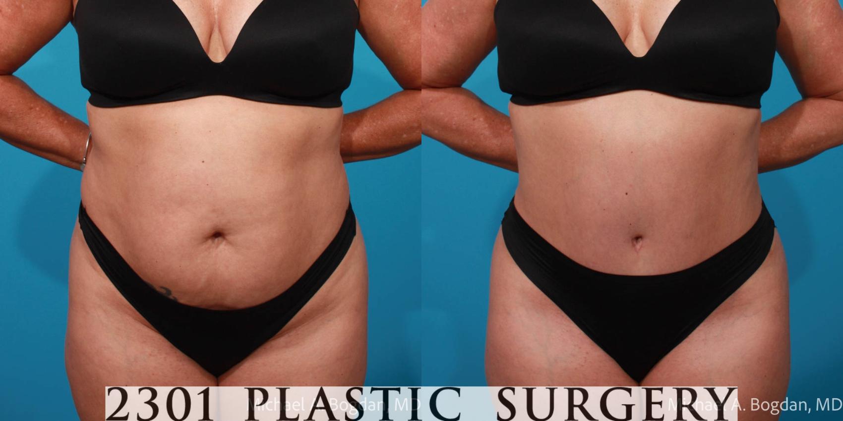 Before & After Tummy Tuck Case 709 Front View in Fort Worth, Plano, & Frisco, Texas