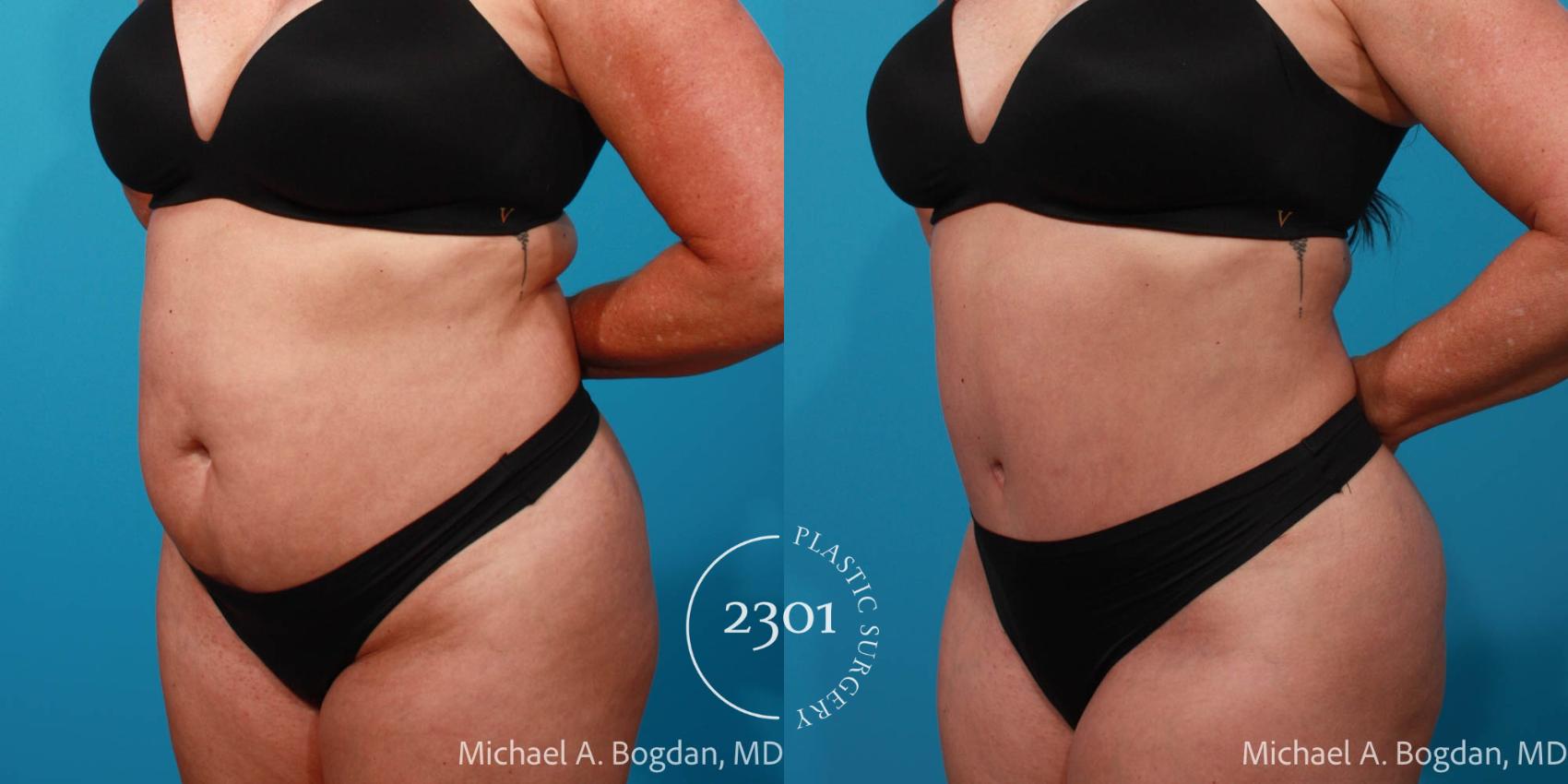 Before & After Tummy Tuck Case 709 Left Oblique View in Fort Worth, Plano, & Frisco, Texas