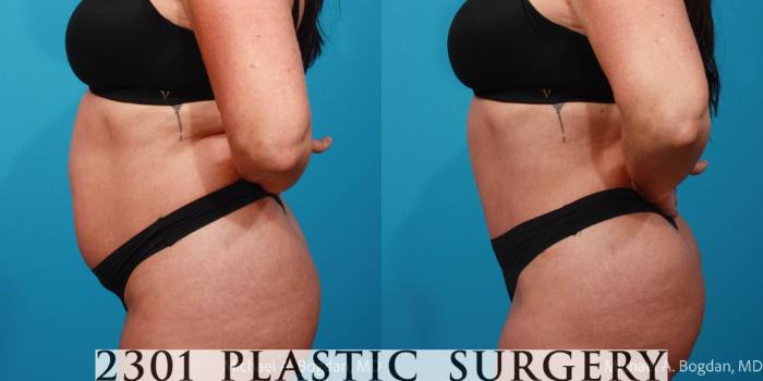 Before & After Tummy Tuck Case 709 Left Side View in Fort Worth, Plano, & Frisco, Texas