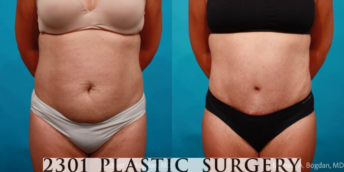 Before & After Tummy Tuck Case 713 Front View in Fort Worth, Plano, & Frisco, Texas