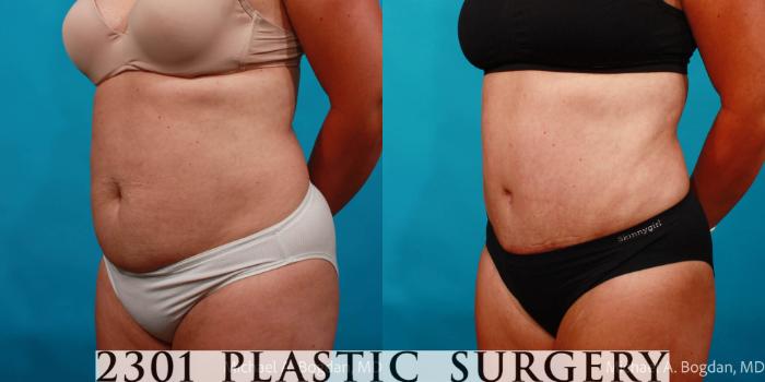 Before & After Tummy Tuck Case 713 Left Oblique View in Fort Worth, Plano, & Frisco, Texas