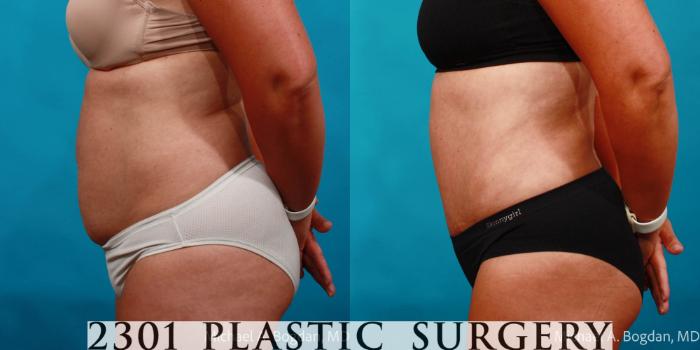 Before & After Tummy Tuck Case 713 Left Side View in Fort Worth, Plano, & Frisco, Texas