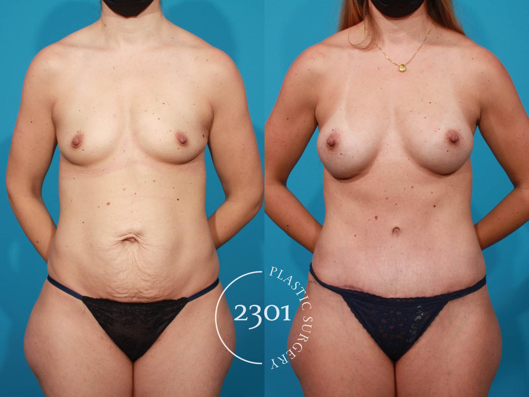 Before & After Silicone Implants Case 717 Front View in Fort Worth, Plano, & Frisco, Texas