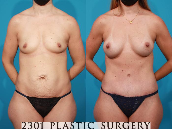 Before & After Breast Augmentation Case 717 Front View in Fort Worth, Plano, & Frisco, Texas