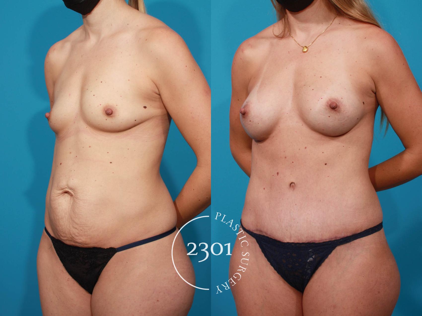 Before & After Silicone Implants Case 717 Left Oblique View in Fort Worth, Plano, & Frisco, Texas