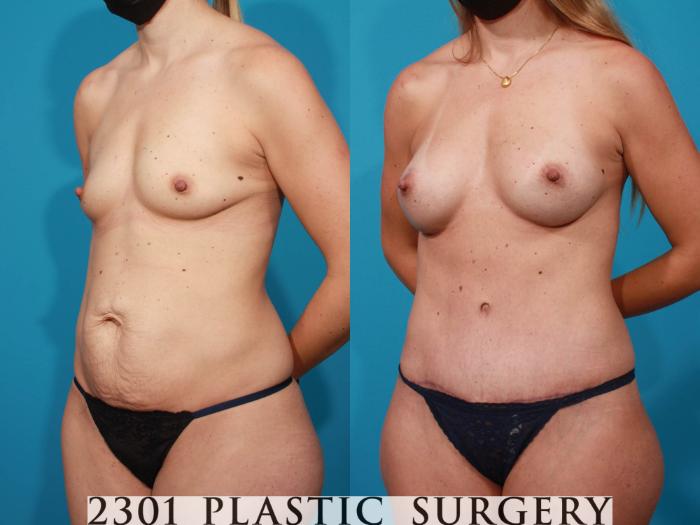 Before & After Tummy Tuck Case 717 Left Oblique View in Fort Worth, Plano, & Frisco, Texas