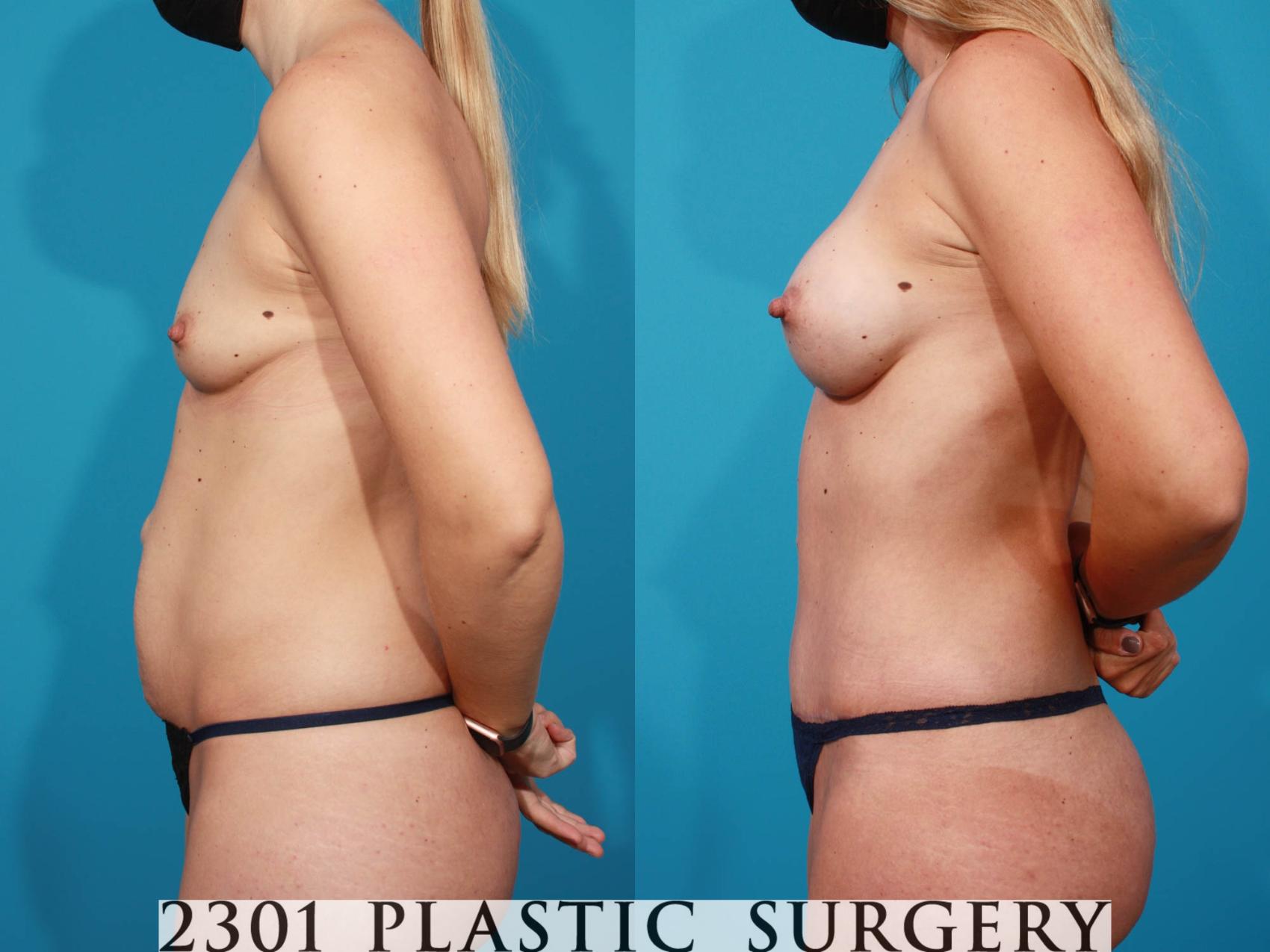 Before & After Tummy Tuck Case 717 Left Side View in Fort Worth, Plano, & Frisco, Texas