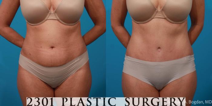 Before & After Tummy Tuck Case 722 Front View in Fort Worth, Plano, & Frisco, Texas