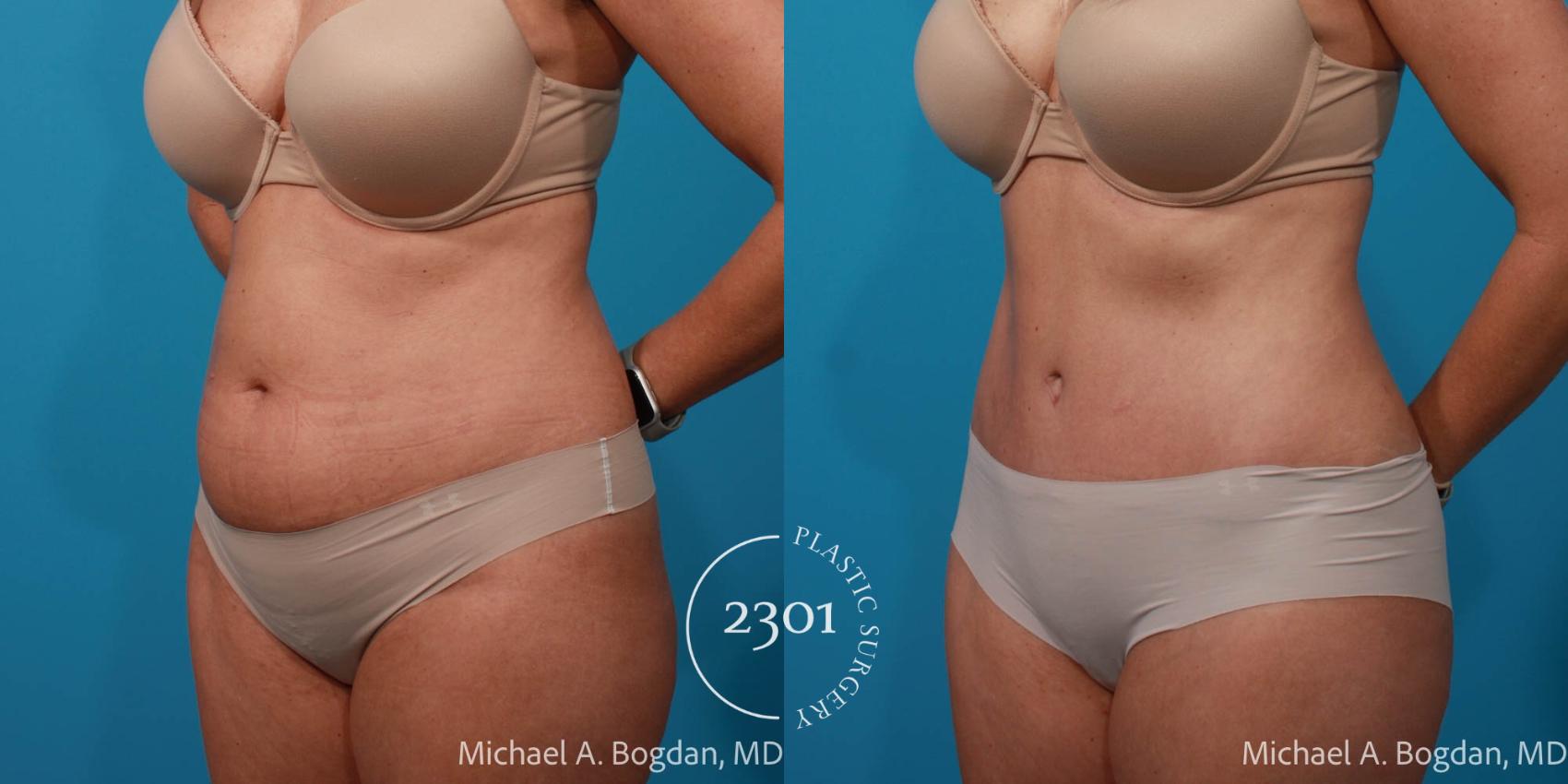 Before & After Tummy Tuck Case 722 Left Oblique View in Fort Worth, Plano, & Frisco, Texas