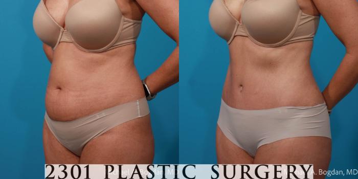 Before & After Tummy Tuck Case 722 Left Oblique View in Fort Worth, Plano, & Frisco, Texas