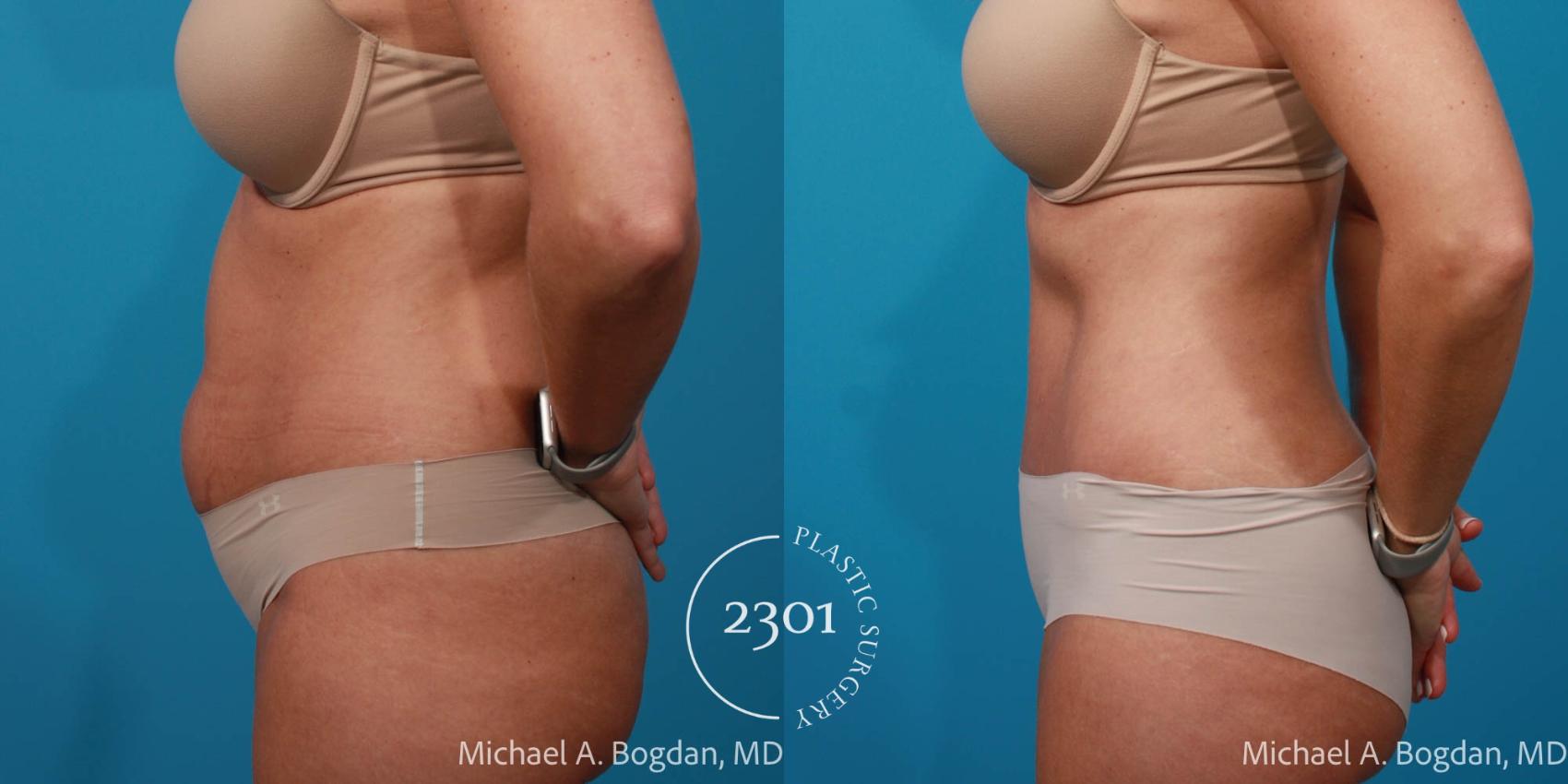 Before & After Tummy Tuck Case 722 Left Side View in Fort Worth, Plano, & Frisco, Texas