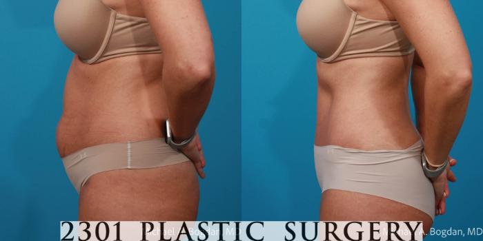 Before & After Tummy Tuck Case 722 Left Side View in Fort Worth, Plano, & Frisco, Texas