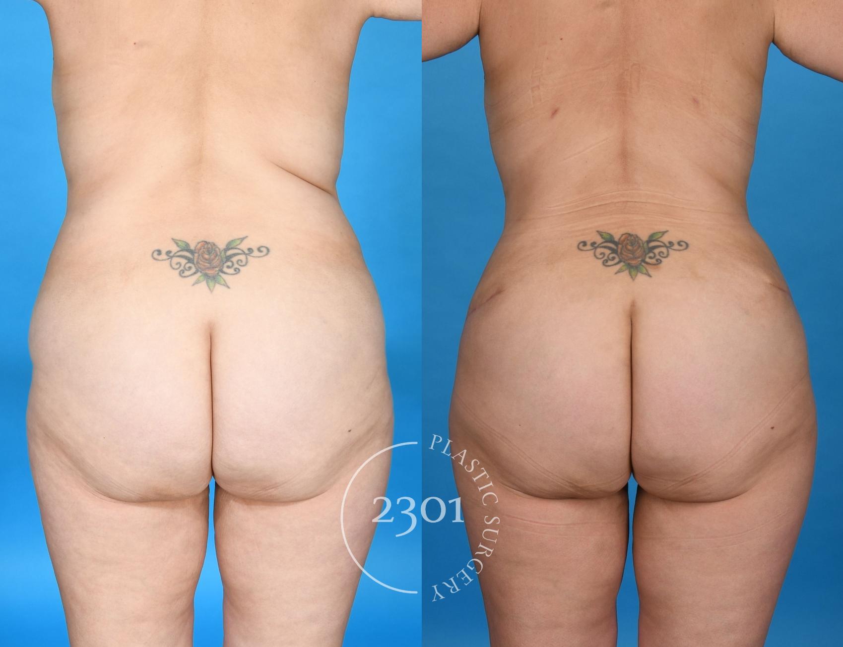 Before & After Liposuction Case 740 Back View in Fort Worth, Plano, & Frisco, Texas