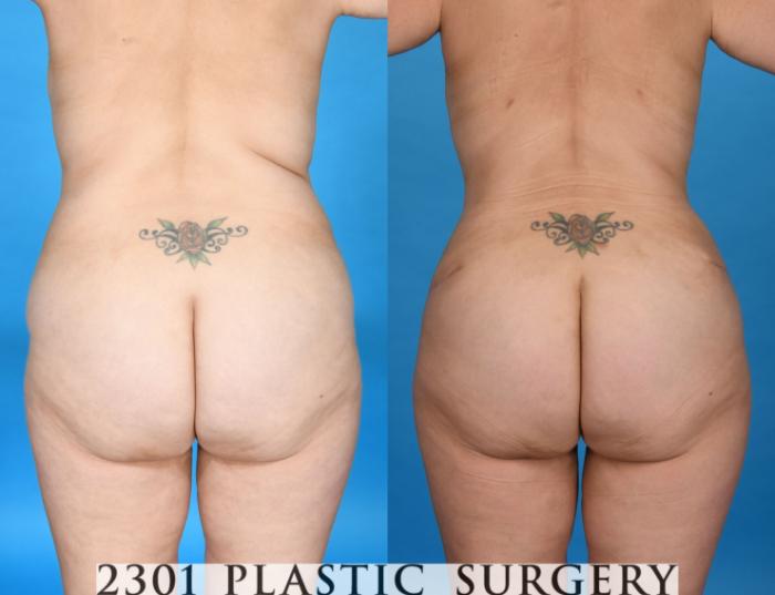 Before & After Tummy Tuck Case 740 Back View in Fort Worth, Plano, & Frisco, Texas