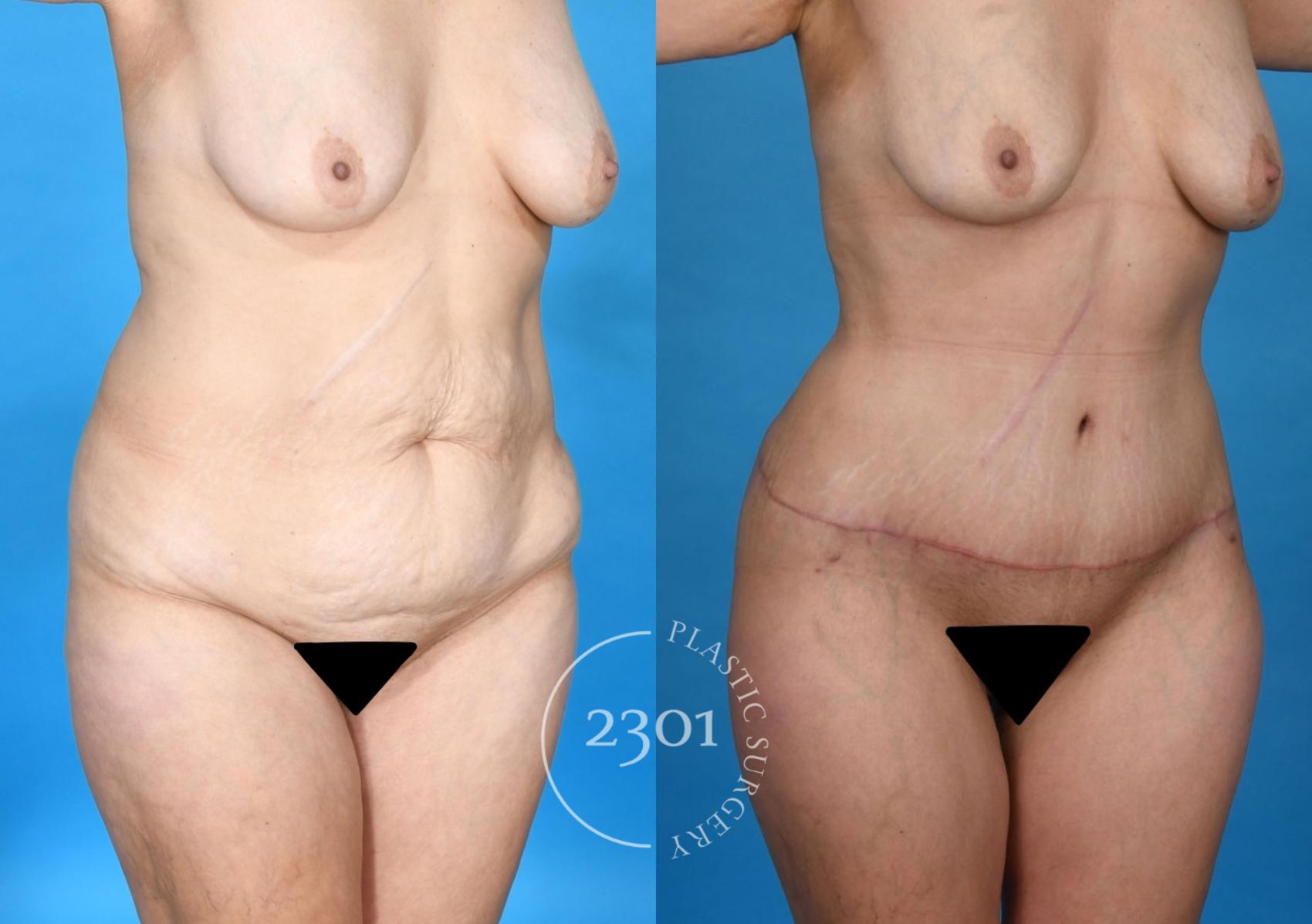 Before & After Liposuction Case 740 Right Oblique View in Fort Worth, Plano, & Frisco, Texas