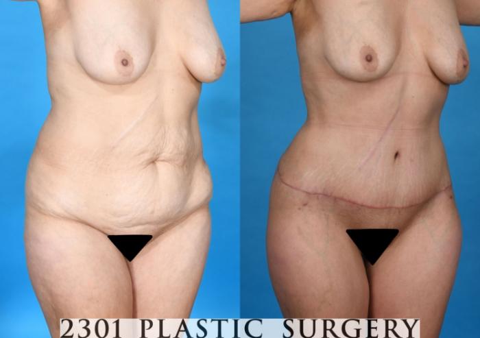 Before & After Liposuction Case 740 Right Oblique View in Fort Worth, Plano, & Frisco, Texas
