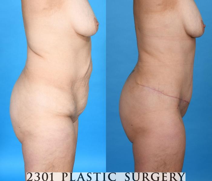 Before & After Tummy Tuck Case 740 Right Side View in Fort Worth, Plano, & Frisco, Texas