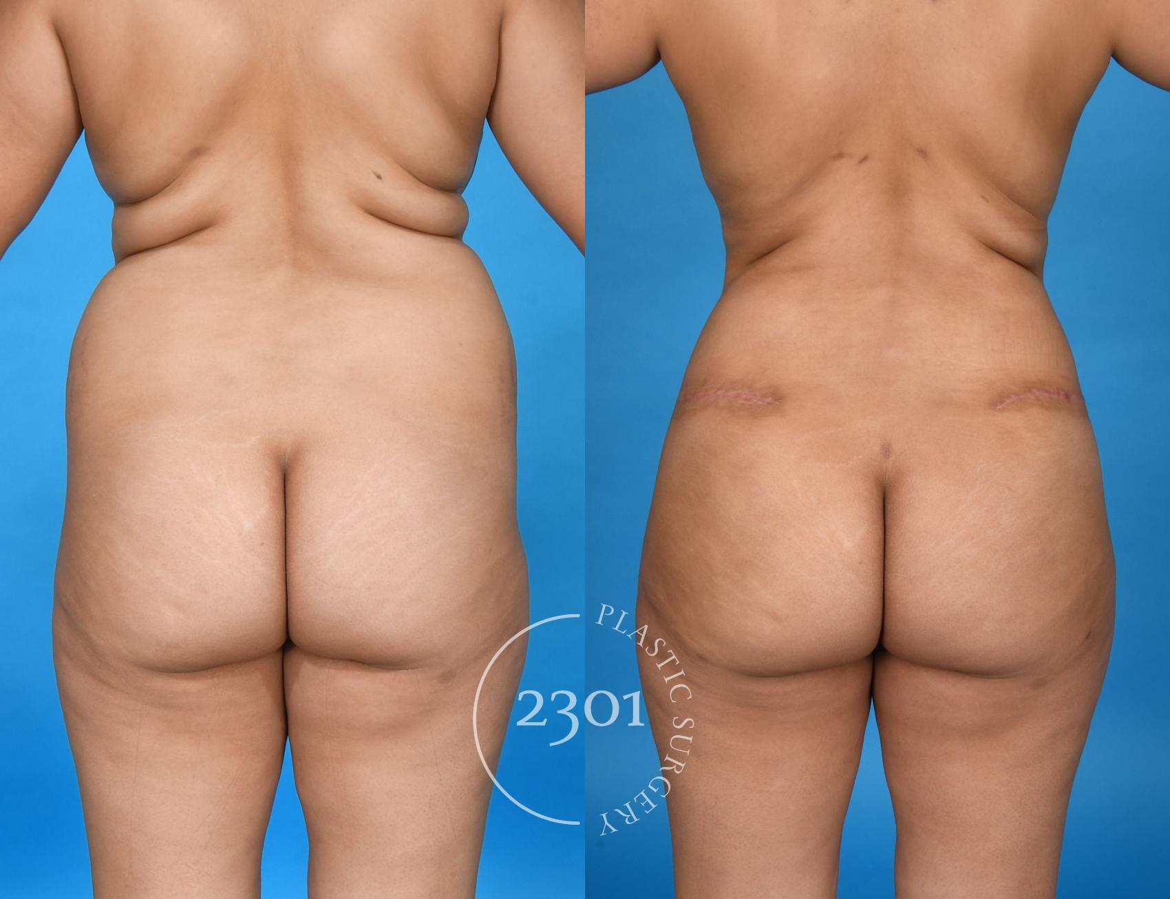 Before & After Liposuction Case 741 Back View in Fort Worth, Plano, & Frisco, Texas