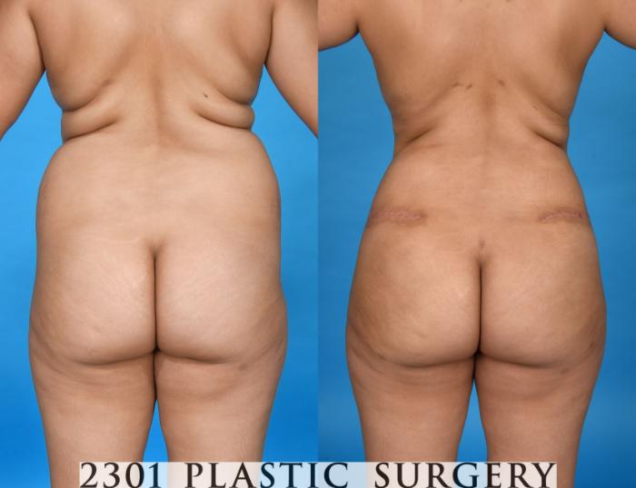 Before & After Liposuction Case 741 Back View in Fort Worth, Plano, & Frisco, Texas
