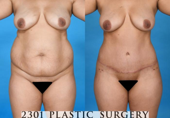 Before & After Liposuction Case 741 Front View in Fort Worth & Frisco, Texas