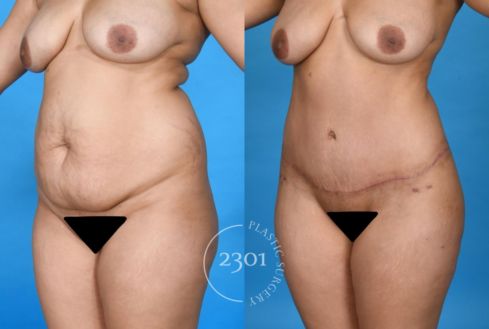 Before & After Liposuction Case 741 Left Oblique View in Fort Worth, Plano, & Frisco, Texas