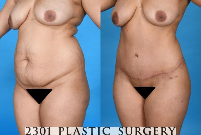 Before & After Liposuction Case 741 Left Oblique View in Fort Worth, Plano, & Frisco, Texas