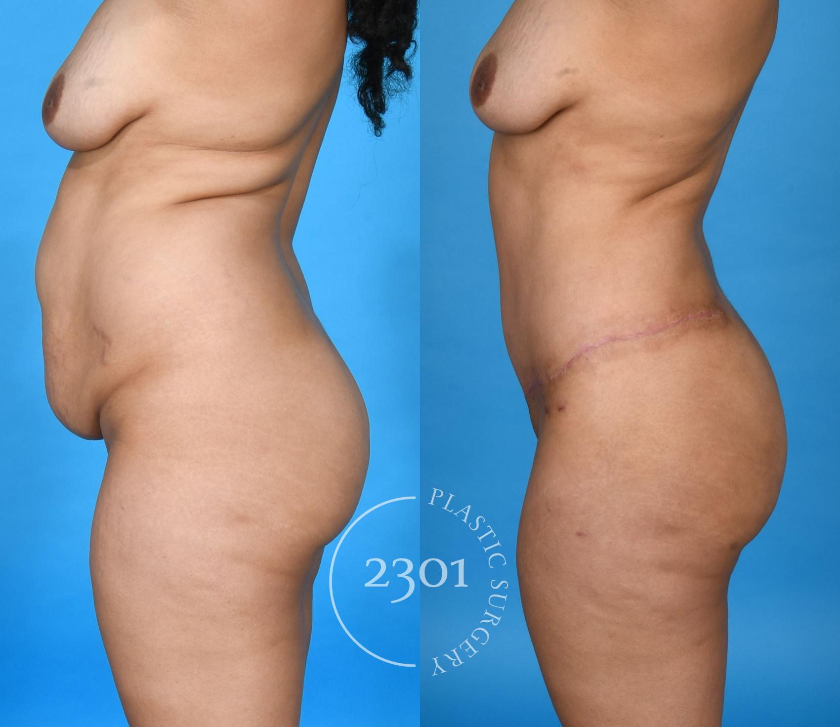 Before & After Liposuction Case 741 Left Side View in Fort Worth, Plano, & Frisco, Texas