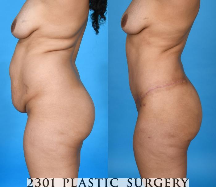 Before & After Liposuction Case 741 Left Side View in Fort Worth, Plano, & Frisco, Texas