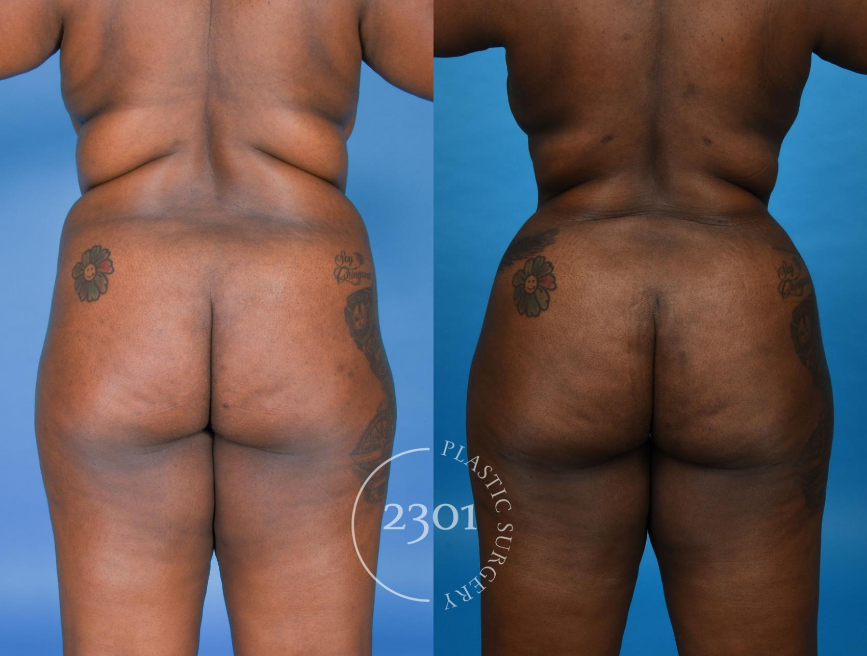 Before & After Gluteal Fat Grafting Case 742 Back View in Fort Worth, Plano, & Frisco, Texas