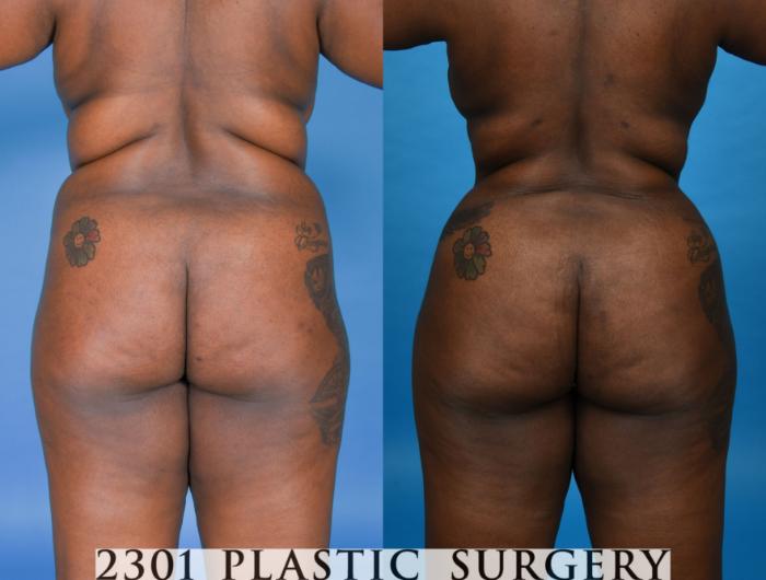 Before & After Tummy Tuck Case 742 Back View in Fort Worth, Plano, & Frisco, Texas