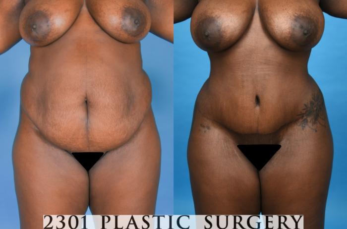 Before & After Tummy Tuck Case 742 Front View in Fort Worth, Plano, & Frisco, Texas