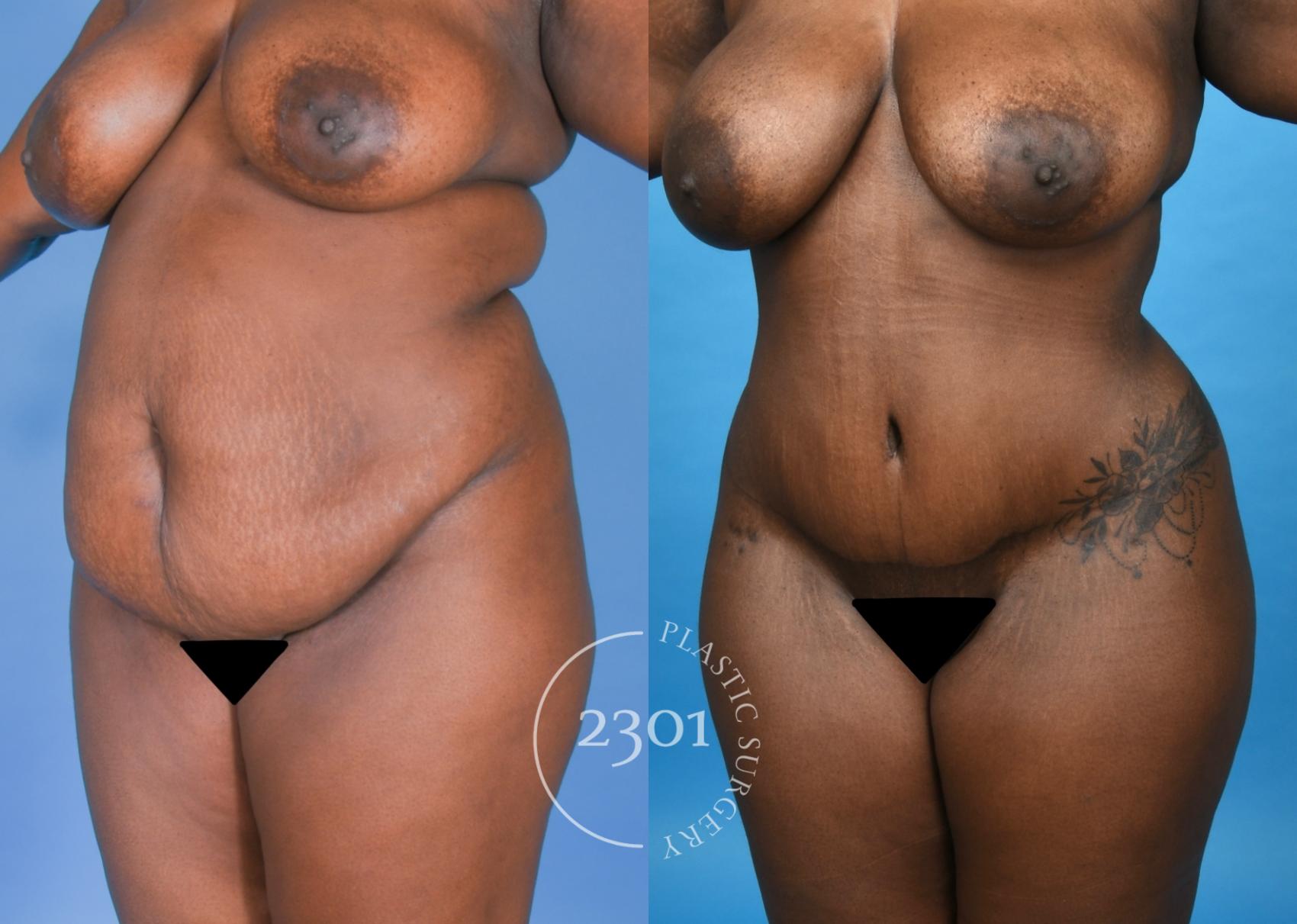 Before & After Gluteal Fat Grafting Case 742 Left Oblique View in Fort Worth, Plano, & Frisco, Texas
