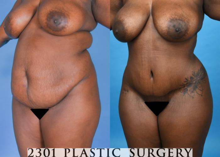 Before & After Tummy Tuck Case 742 Left Oblique View in Fort Worth, Plano, & Frisco, Texas