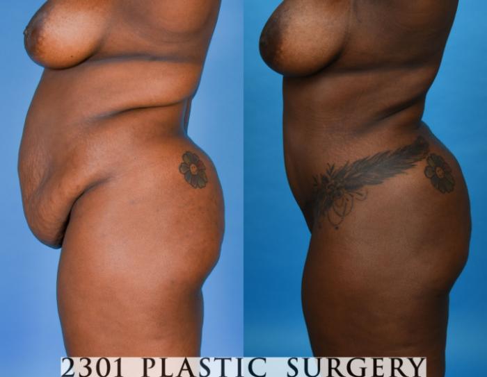 Before & After Tummy Tuck Case 742 Left Side View in Fort Worth, Plano, & Frisco, Texas