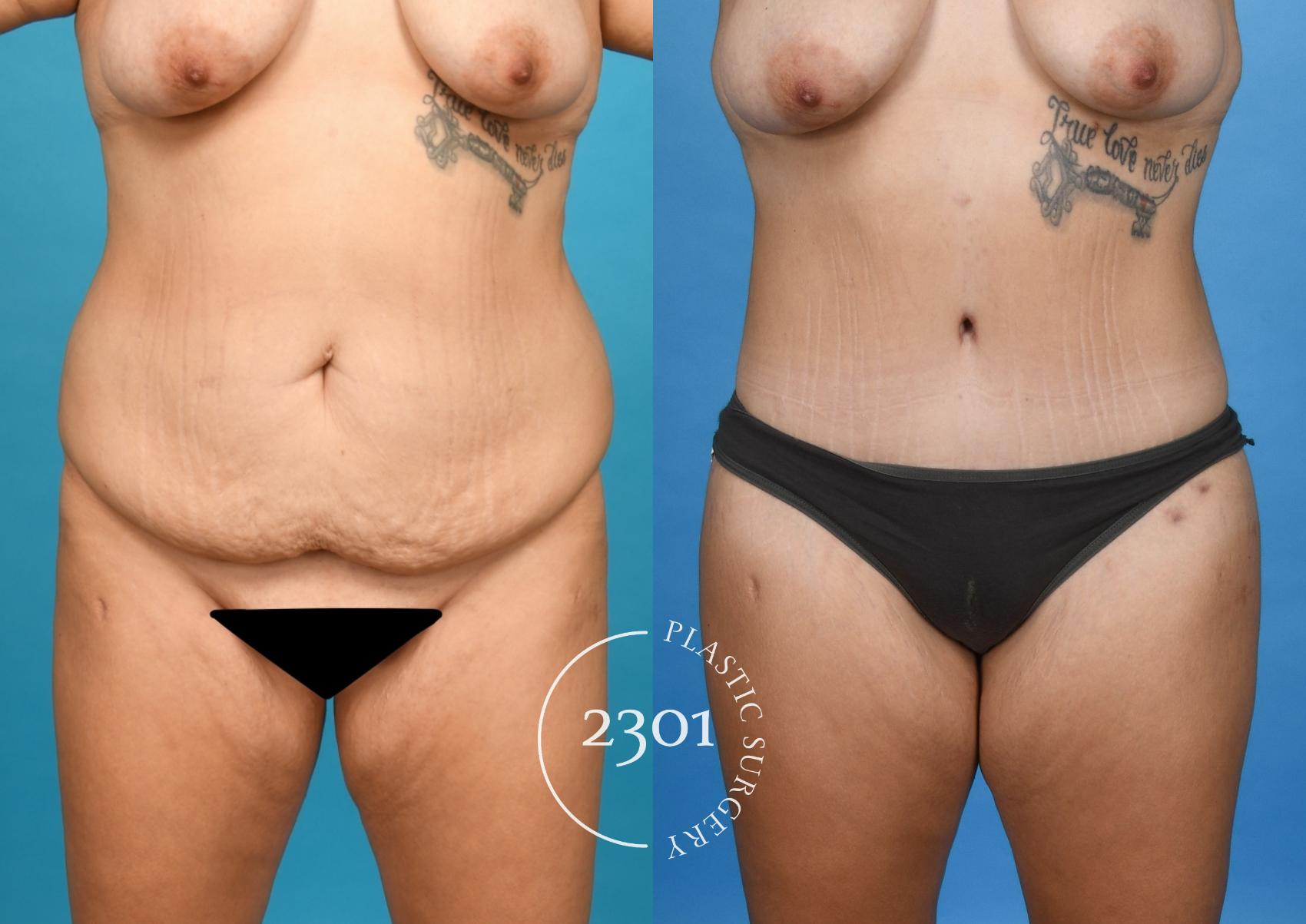 Before & After Liposuction Case 745 Front View in Fort Worth, Plano, & Frisco, Texas