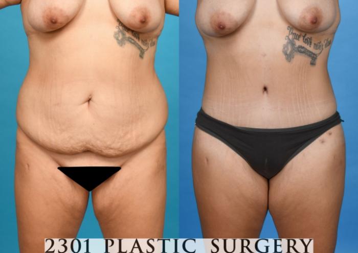 Before & After Post-Bariatric Plastic Surgery Case 745 Front View in Fort Worth, Plano, & Frisco, Texas