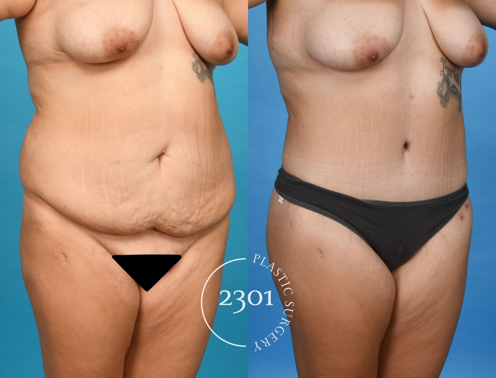 Before & After Tummy Tuck Case 745 Right Oblique View in Fort Worth, Plano, & Frisco, Texas