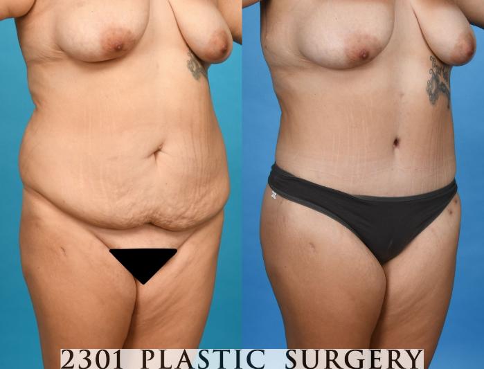 Before & After Tummy Tuck Case 745 Right Oblique View in Fort Worth, Plano, & Frisco, Texas